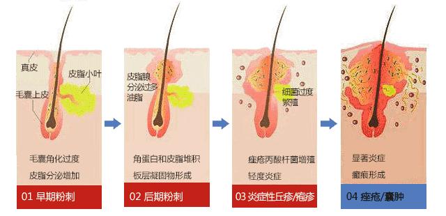 痘痘闭口摸起来软软的,痘痘摸上去硬硬反反复复