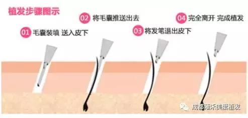 想要治疗遗传性脱发,原来还是要从这点入手……