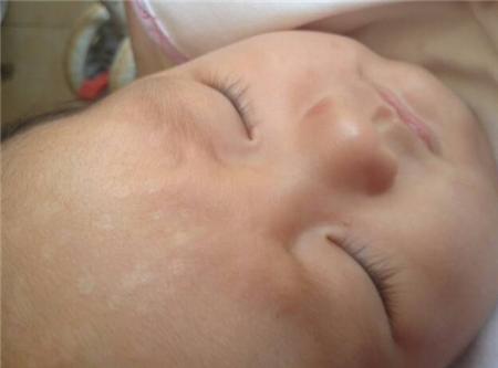 家里两个孩子都长白癜风怎么回事,孩子身上有两块白斑该怎么查