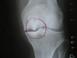 解析骨刺的几大常见问题,骨刺有多可怕视频