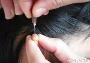 麦粒肿一般眼药水有用吗,中医眼科专家麦粒肿