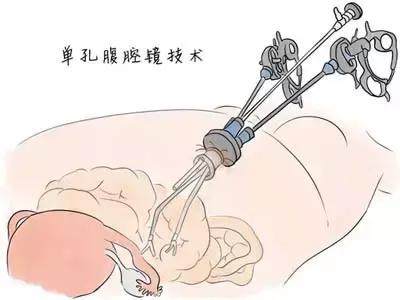 无瘢痕手术:单孔腹腔镜,让爱美女性不再为“疤”苦恼