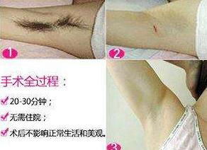 狐臭手术2021价目表,做狐臭手术需要多少费用