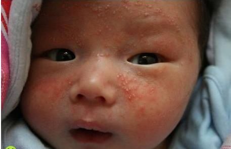 湿疹溃烂流水可以用激素类药膏吗,婴儿湿疹不好可以一直用激素药吗