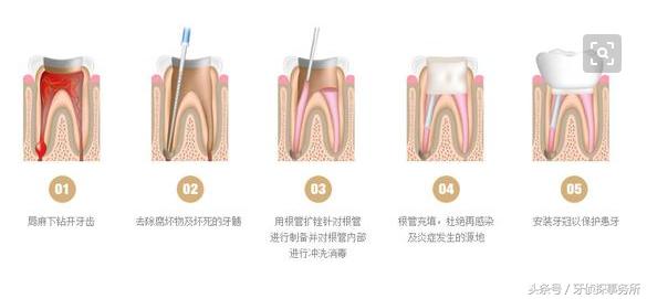 牙齿杀神经后连着耳朵里疼,牙齿杀神经之后一碰就疼