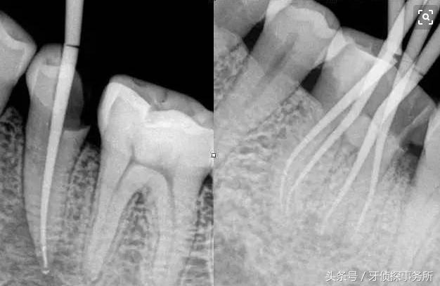 牙齿杀神经后连着耳朵里疼,牙齿杀神经之后一碰就疼