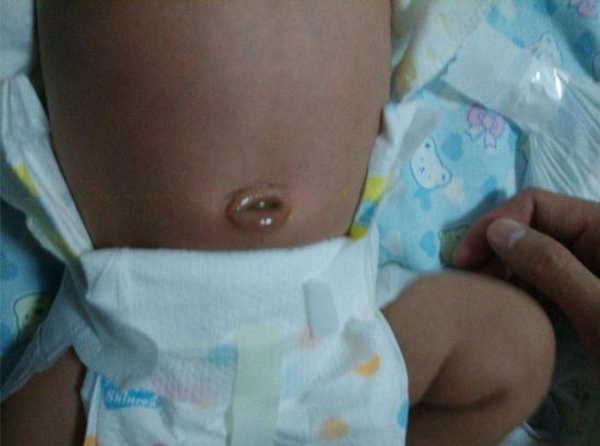 宝宝脐带刚掉脐窝是怎样的,一个多月婴儿脐带有黄水