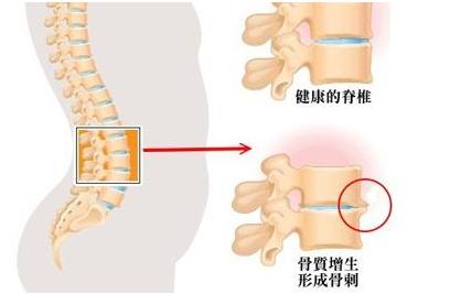 骨质增生骨刺怎么治疗能根除,骨质增生怎么治才能彻底治好骨刺