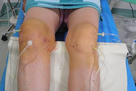 骨质增生骨刺怎么治疗能根除,骨质增生怎么治才能彻底治好骨刺