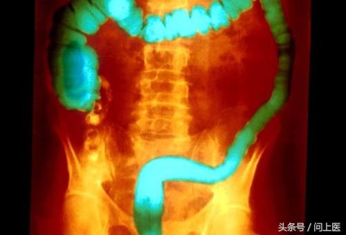 溃疡性结肠炎初期症状及治疗,溃疡性结肠炎症状最新治疗方法