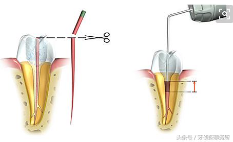 牙齿杀神经后连着耳朵里疼,牙齿杀神经之后一碰就疼