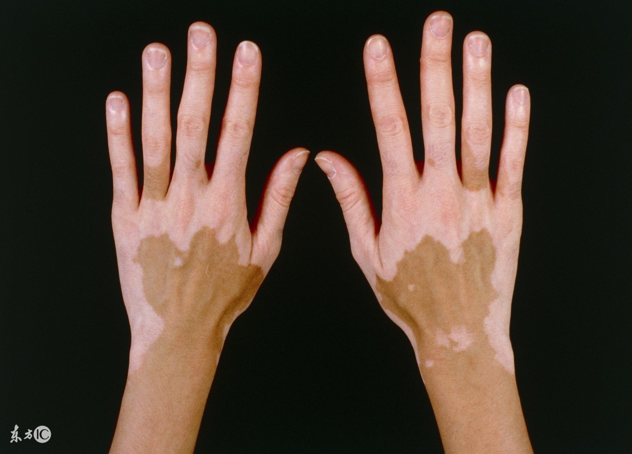 白癜风可以治愈吗用什么方式最佳,白癜风能治愈吗概率多大