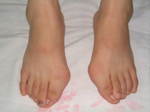 怎样改善x腿型和o腿型,通过调整脚型来改善x型腿