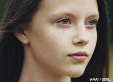 光电祛疤效果图,光电祛斑拯救麻子脸