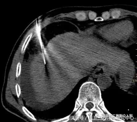 微波消融术后肿块多久才能消,甲状腺肿块微波消融