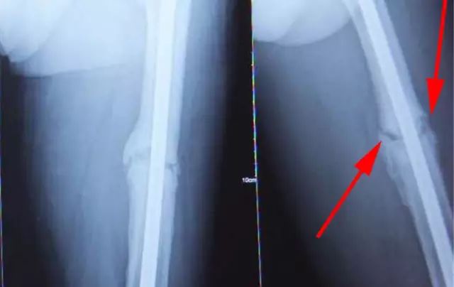 骨折后锻炼身体可以加速骨折愈合,肋骨骨折愈合期二次骨折症状