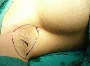 狐臭手术2021价目表,做狐臭手术需要多少费用