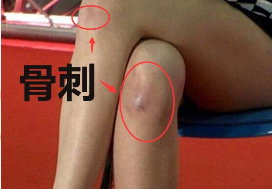 骨质增生骨刺怎么治疗能根除,骨质增生怎么治才能彻底治好骨刺