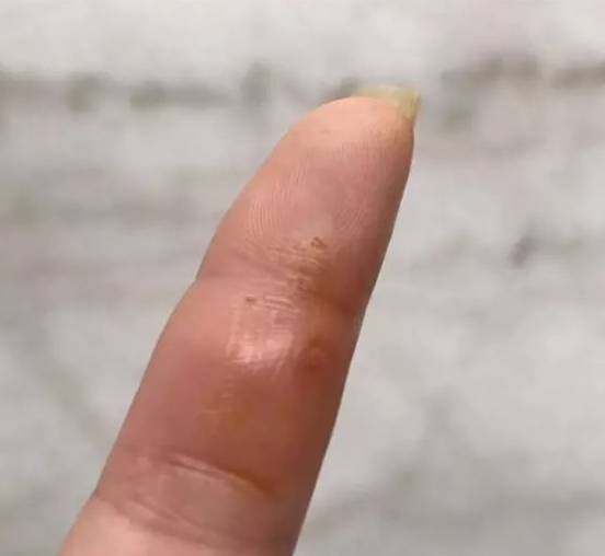 徐州一老师被牙签扎伤，去5次医院都没治好，最后竟然要手术！