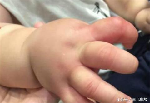 4个月宝宝手指肿了怎么回事,未满月的宝宝手指有点肿