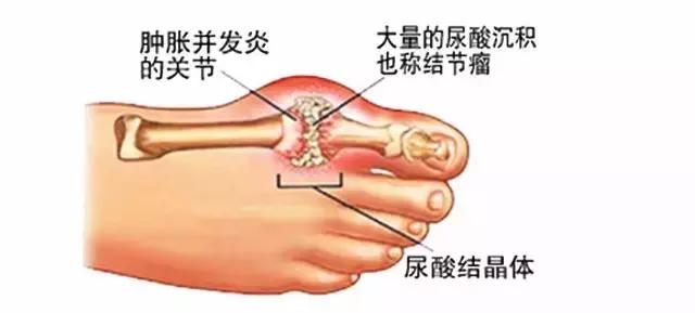 警惕痛风的8个误区,痛风患者需要避免的三个误区