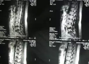 腰椎间盘膨出突出和脱出的区别,腰椎间盘突出膨出脱出哪个更严重