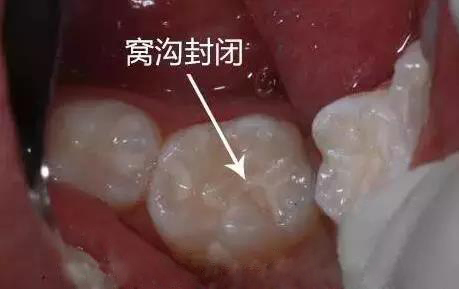 牙齿槽沟黑了还有办法去掉吗,怎样去掉牙齿上的黑垢