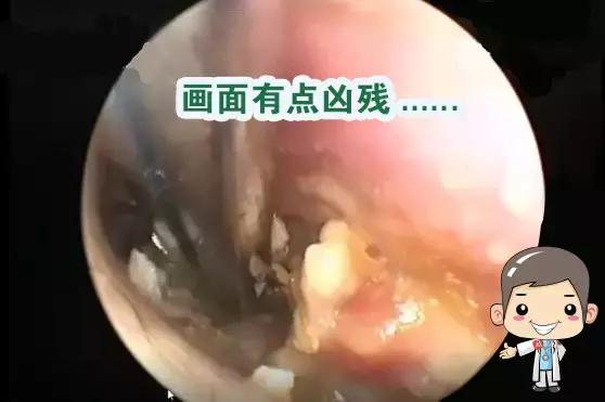 不是奇谈｜小伙儿耳内取出蚕豆大小胆脂瘤，自称耳痛10年未曾就医