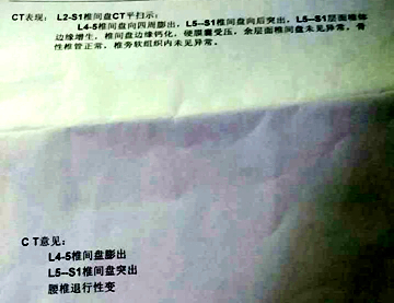 腰椎间盘膨出突出和脱出的区别,腰椎间盘突出膨出脱出哪个更严重