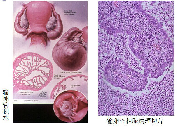 试管前发现有输卵管积水怎么办,试管婴儿要做输卵管造影么