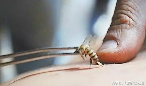 蜂针治疗后为什么痒,蜂刺红肿怎么处理