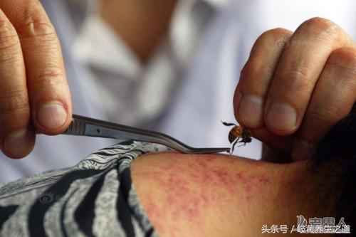 蜂针治疗后为什么痒,蜂刺红肿怎么处理