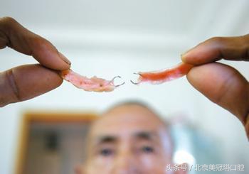 有一种毁容叫戴眼镜,牙齿正畸毁容案例