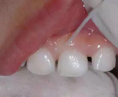 牙齿槽沟黑了还有办法去掉吗,怎样去掉牙齿上的黑垢