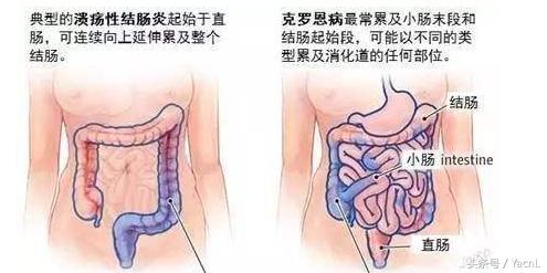干细胞治疗牙髓炎症,干细胞医疗最新报道