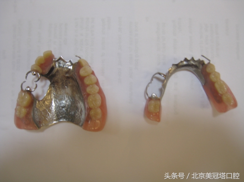 有一种毁容叫戴眼镜,牙齿正畸毁容案例