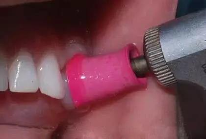 牙齿槽沟黑了还有办法去掉吗,怎样去掉牙齿上的黑垢