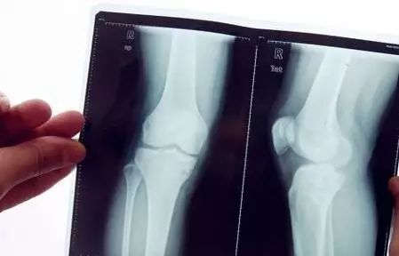 骨折后锻炼身体可以加速骨折愈合,肋骨骨折愈合期二次骨折症状