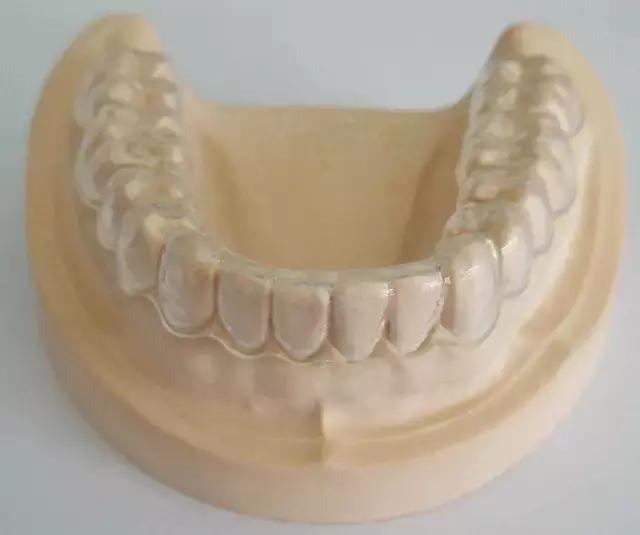 矫正后戴保持器需要多长时间,矫正保持器需要终身佩戴吗