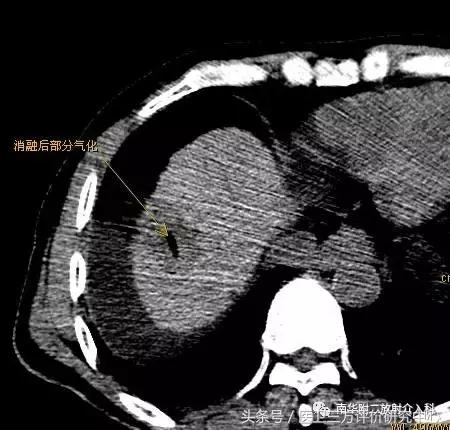 微波消融术后肿块多久才能消,甲状腺肿块微波消融
