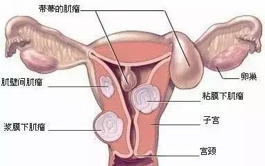 子宫肌瘤对怀孕有影响吗,子宫肌瘤对怀孕影响大不大