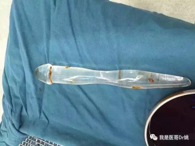涨奶引起急性乳腺炎怎么办,奶涨到什么程度会得乳腺炎