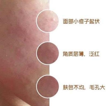 激素依赖性皮炎症状及治疗方法,激素依赖性皮炎面部症状