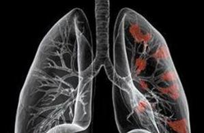防治肺癌莫掉入这些误区