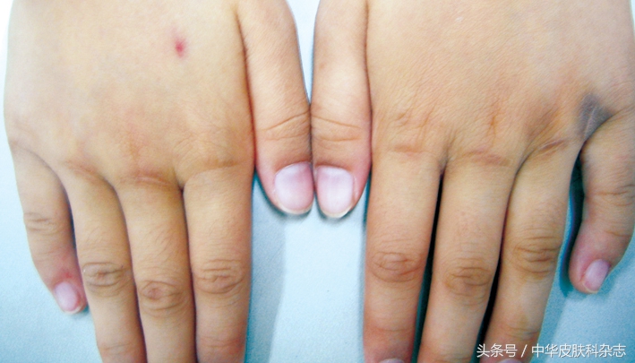 手部发黑怎么回事,摩擦性黑变病的症状有哪些