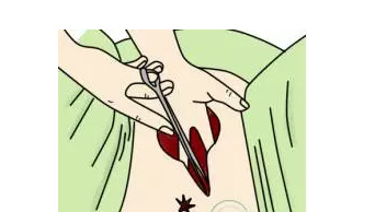 顺产时，自然撕裂、侧切哪个恢复快？有什么区别和影响