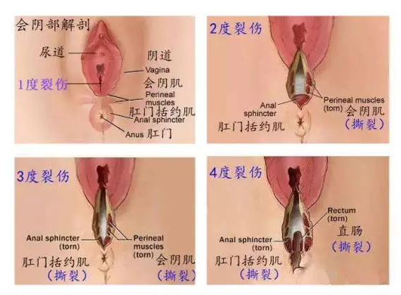 顺产时，自然撕裂、侧切哪个恢复快？有什么区别和影响