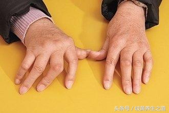 蜂疗类风湿性关节炎,蜂疗类风湿的穴位