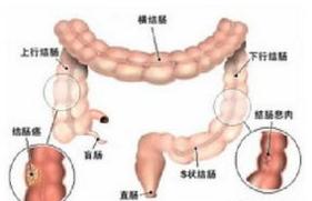 肠癌晚期患者腹胀的最快治疗方法,肠癌手术后腹胀腹痛怎么回事