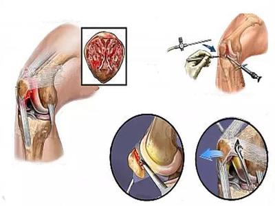 骨科微创手术关节镜技术科普知识,关节镜微创真实案例